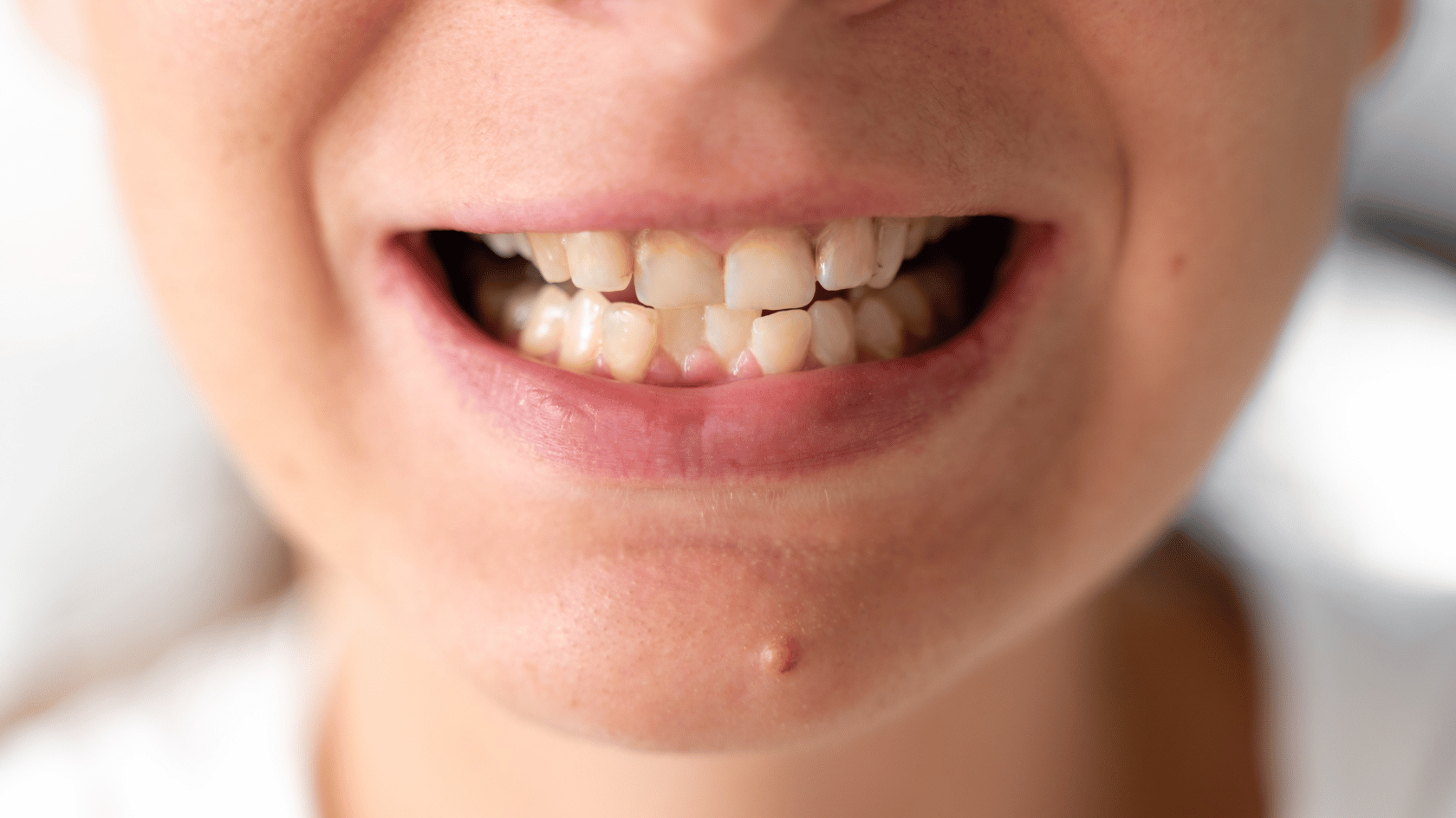 Ketika Gigi Tak Seirama: Mengenal Maloklusi, Si Pengganggu Senyum Sehat