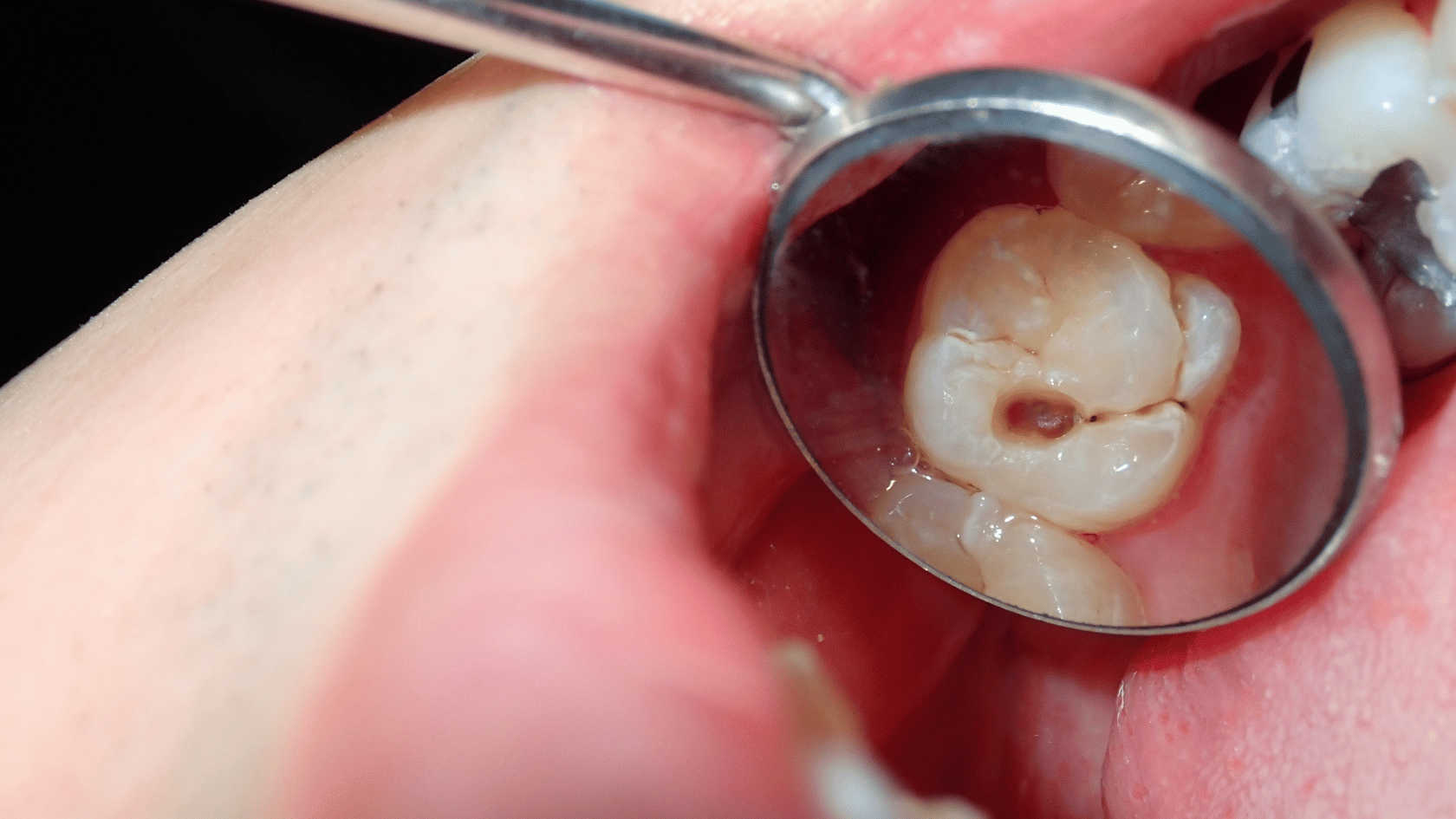 Sakit Gigi Tapi Lubang Kecil: Kok Bisa Sampai Sakit Kepala?