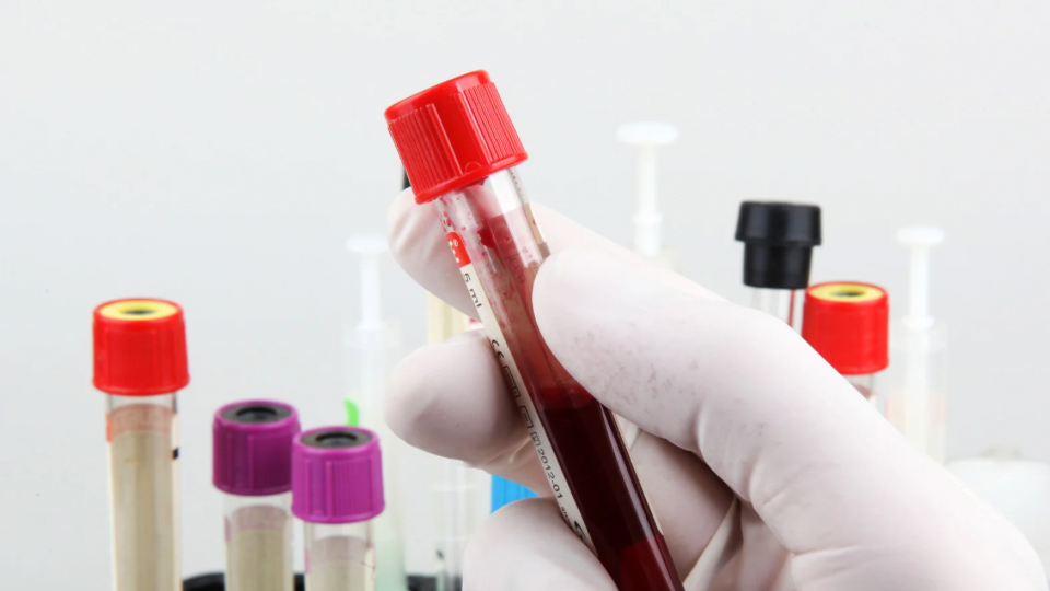 Pemeriksaan Widal: Tes Diagnostik untuk Tifus yang Perlu Diketahui